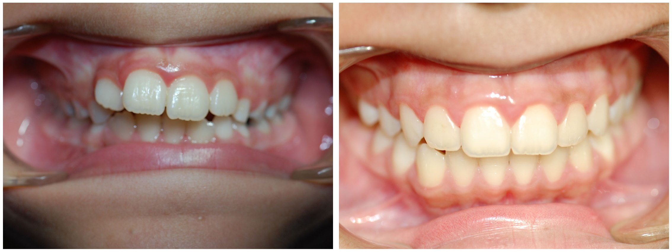 Childrens Dental Braces Treatment Before & After