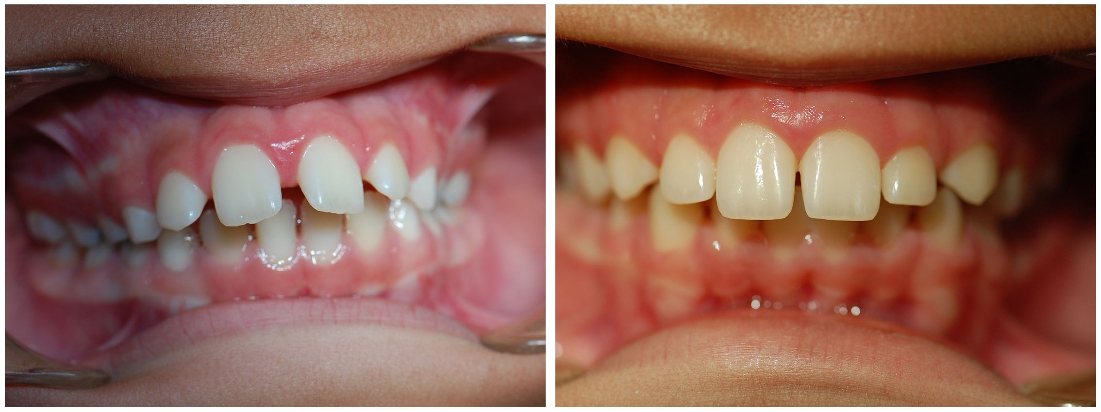 Childrens Dental Braces Treatment Before & After