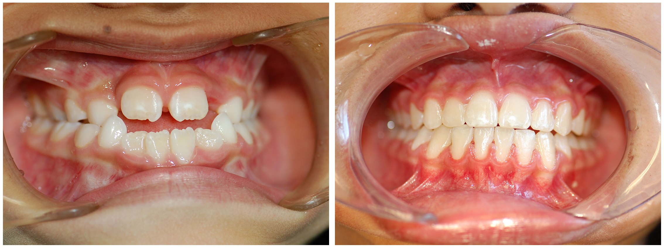 Childrens Dental Braces Before & After