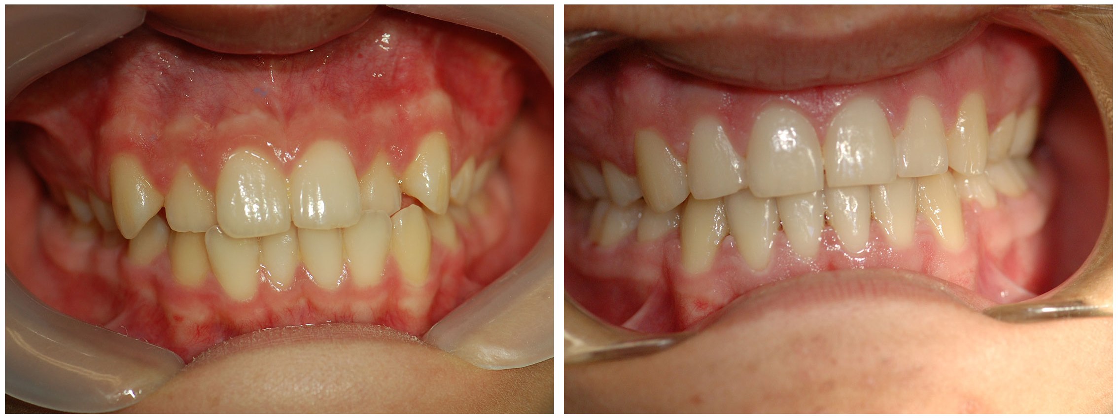 Childrens Dental Braces Before & After