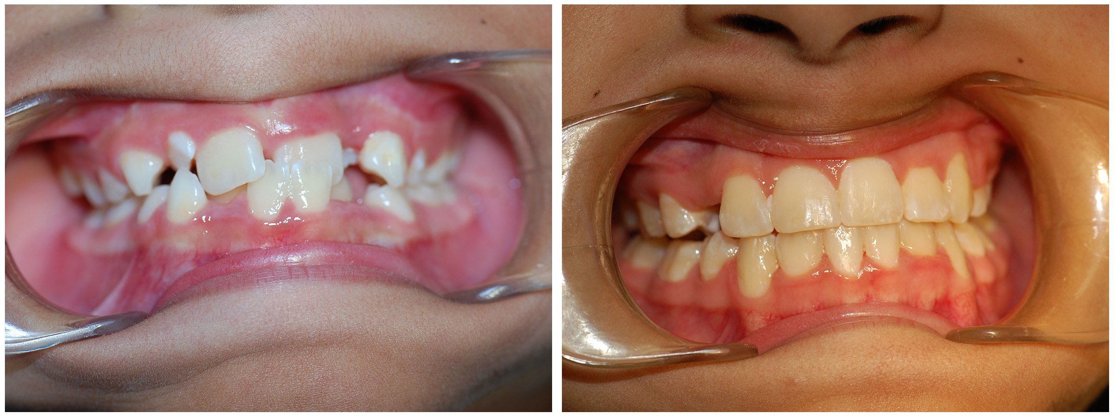 East Palo Alto Dental Braces Treatment Before & After