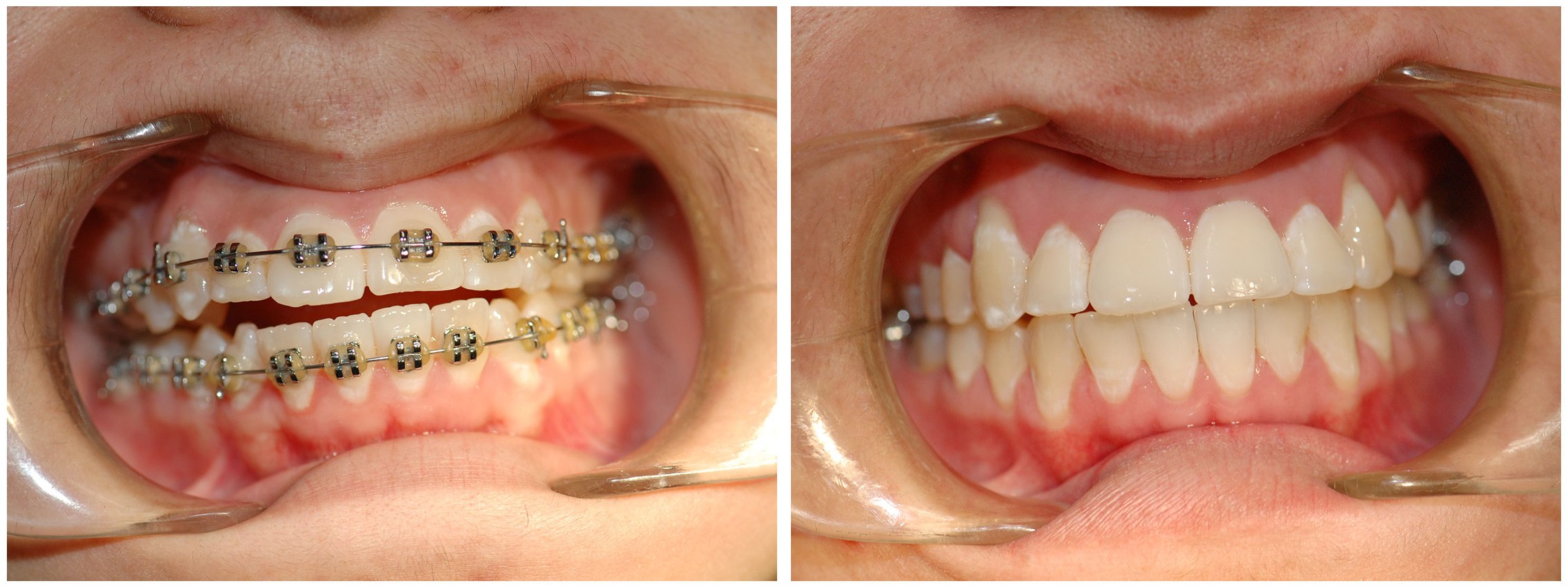 Infant Dental Braces Treatment Before & After