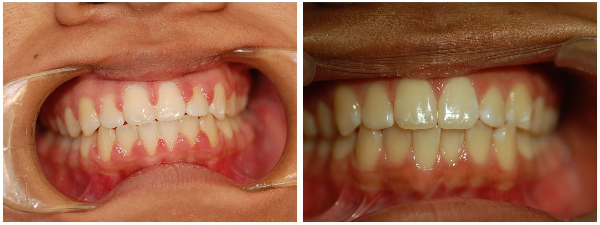 Infant Dental Braces Treatment Before & After