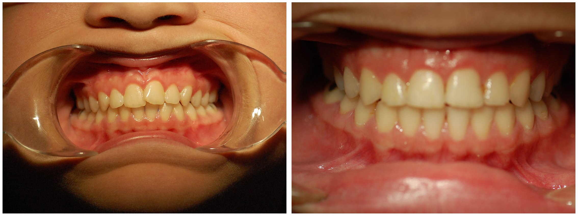 Infant Dental Braces Before & After