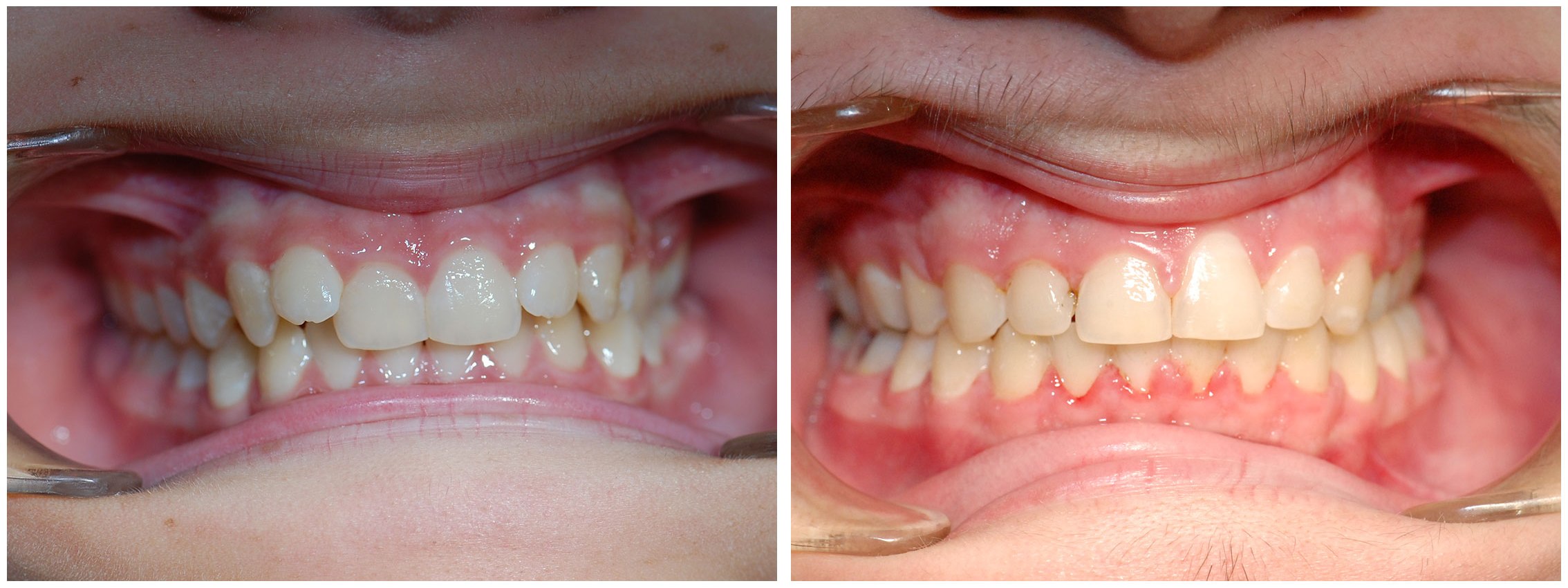 Infant Dental Braces Before & After