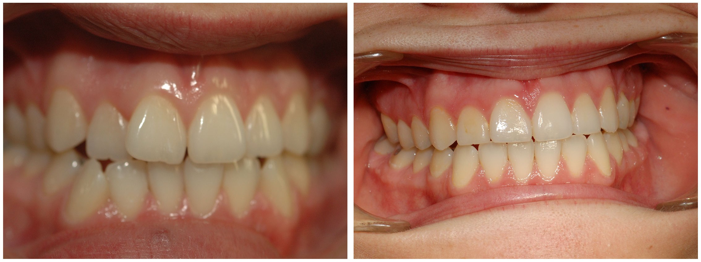 Infant Dental Braces Before & After