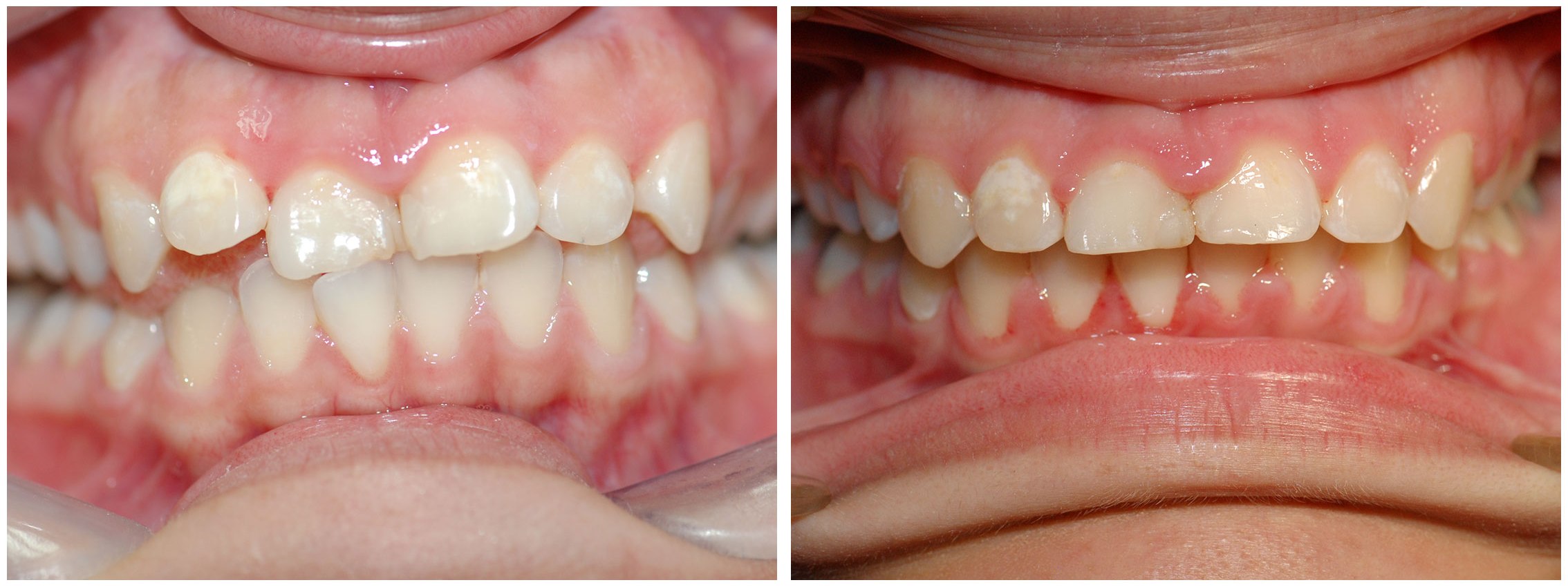 Infant Dental Braces Before & After