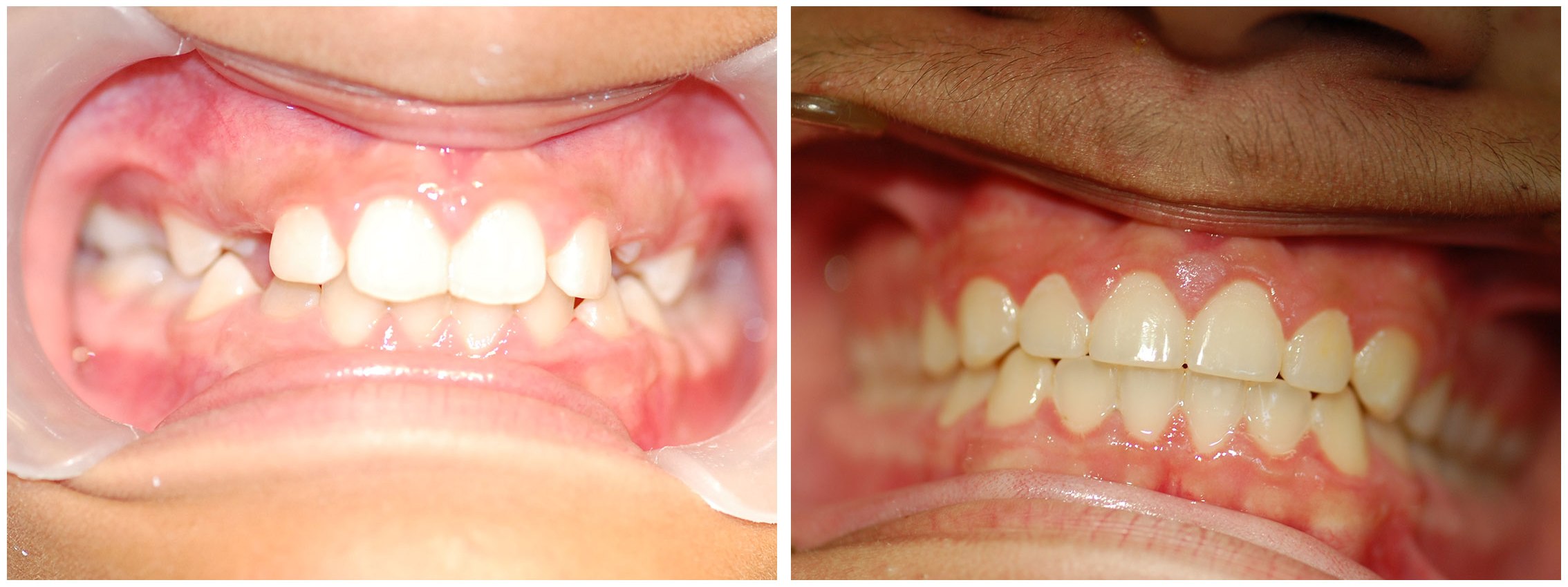 Kids Dental Braces Before & After