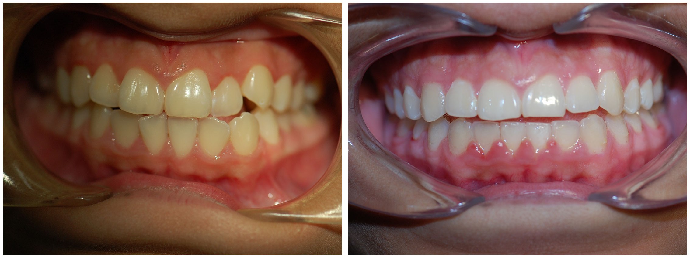 Orthodontic Dental Braces Treatment Before & After