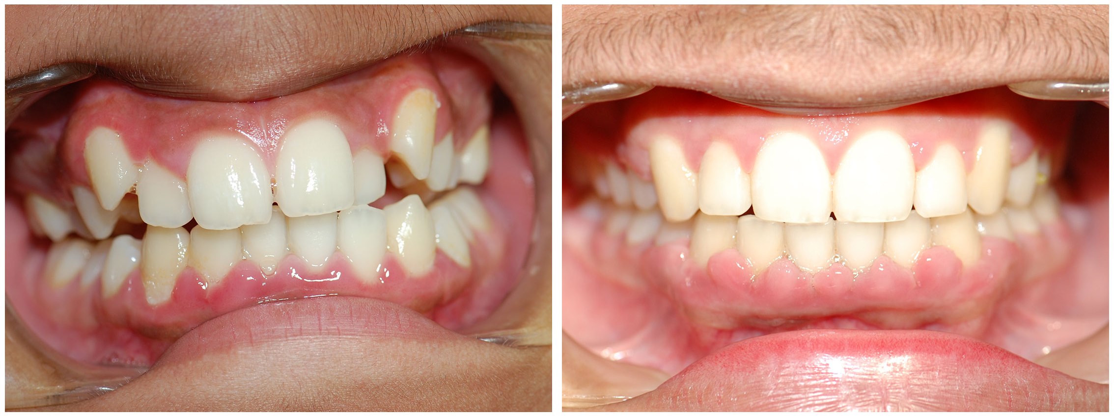 Orthodontic Dental Braces Treatment Before & After