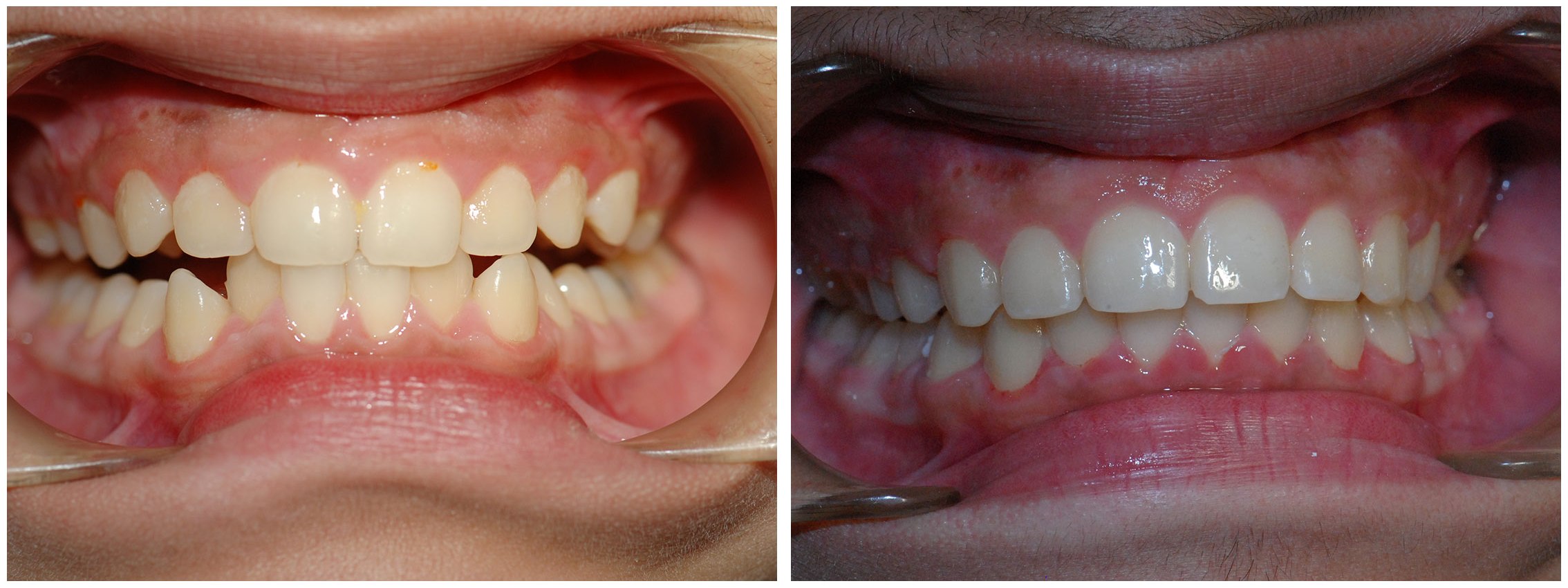Orthodontic Dental Braces Treatment Before & After