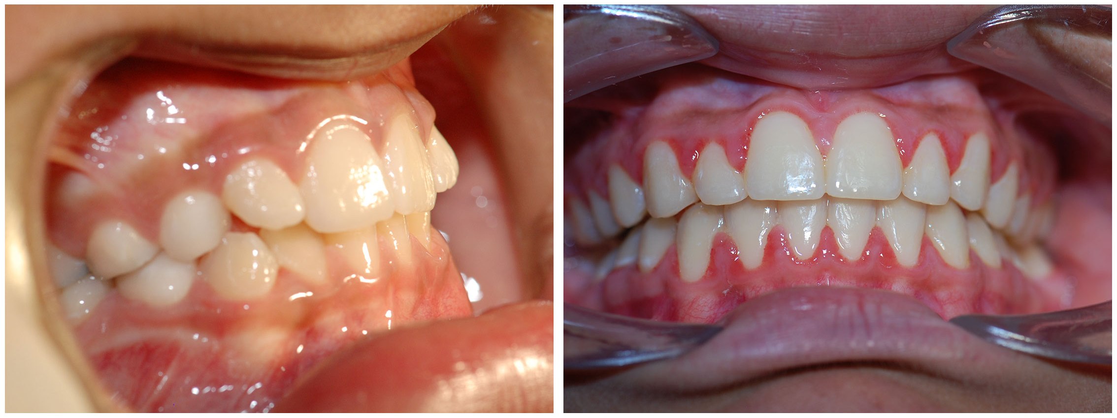 Orthodontic Dental Braces Before & After