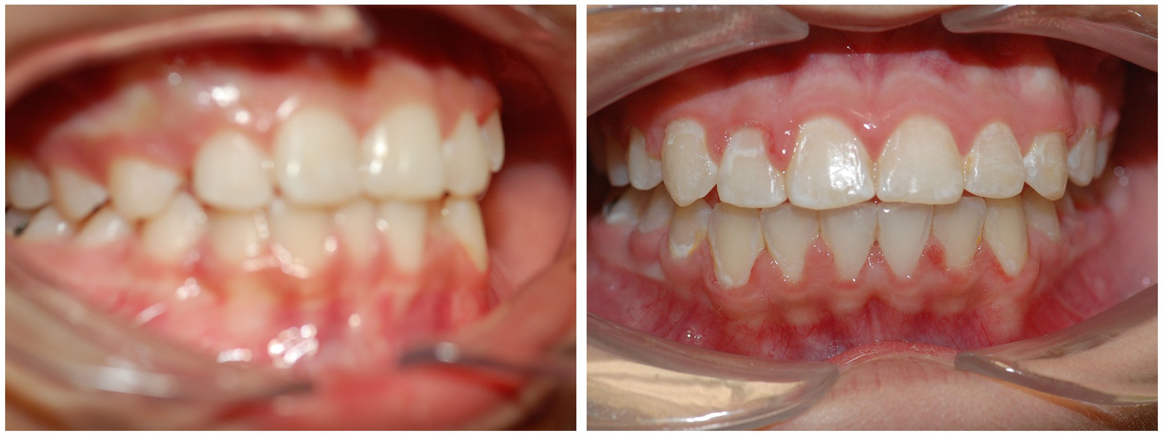 Orthodontic Dental Braces Before & After