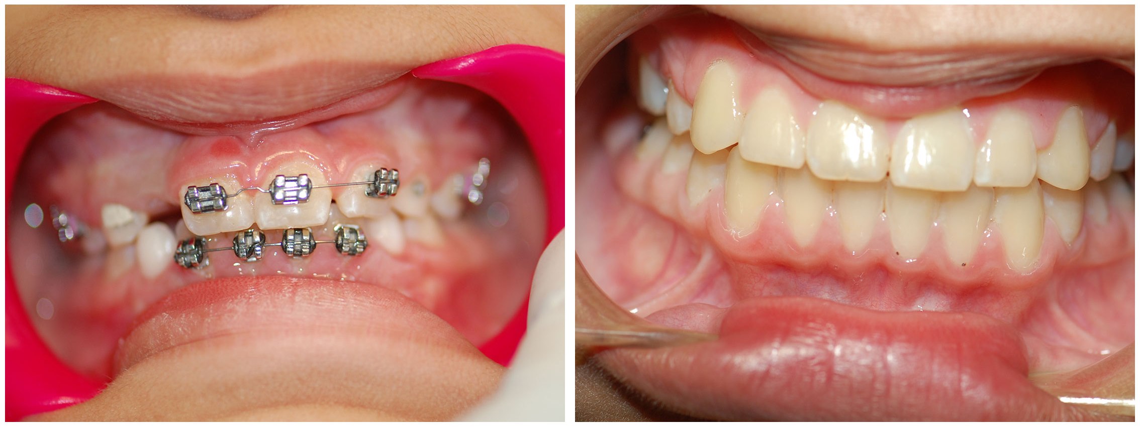 Orthodontic Dental Braces Before & After