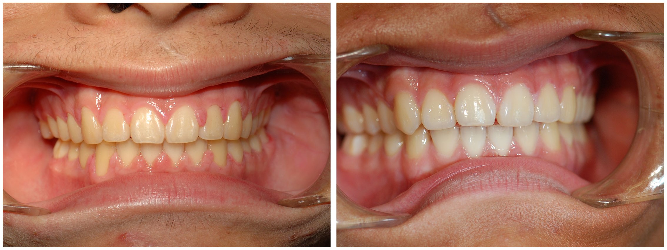 Orthodontic Dental Braces Before & After