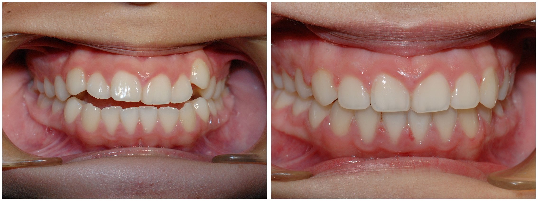 Orthodontist Dental Braces Treatment Before & After