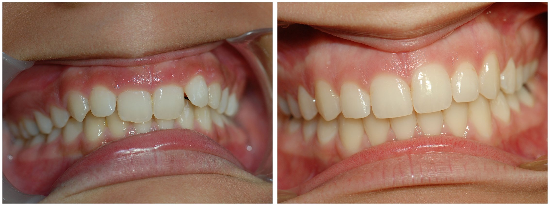 Orthodontist Dental Braces Treatment Before & After