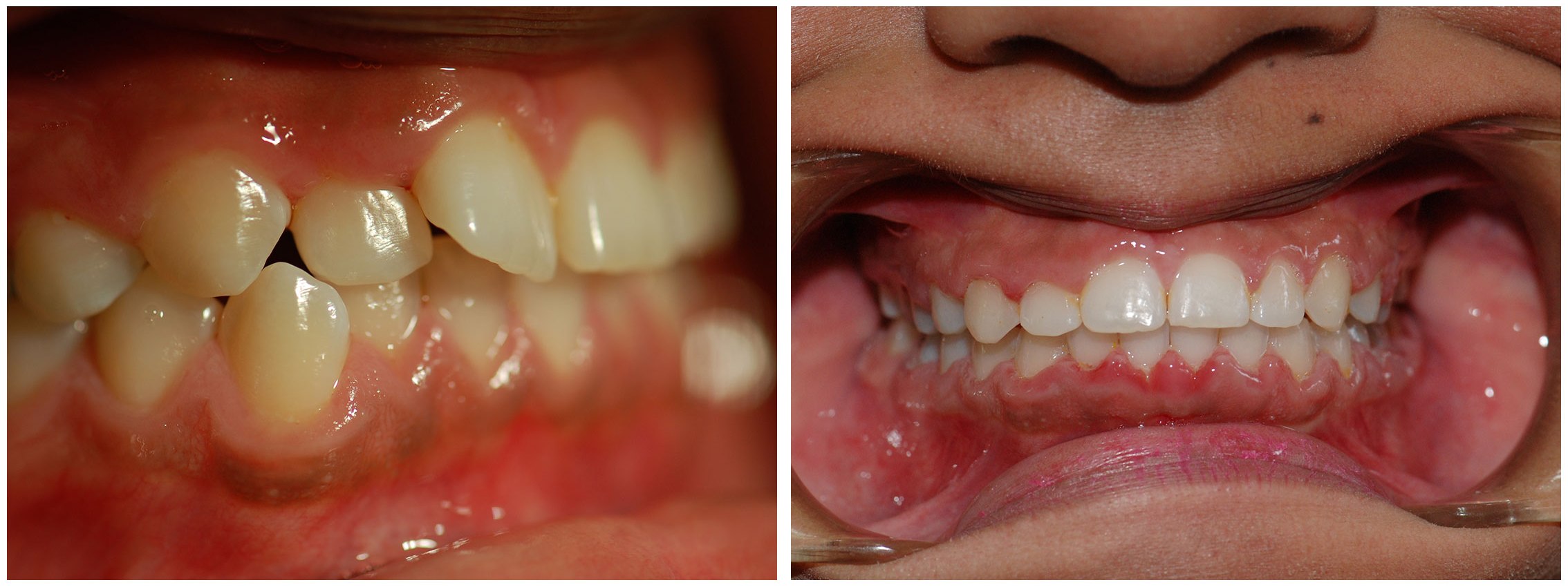 Orthodontist Dental Braces Before & After