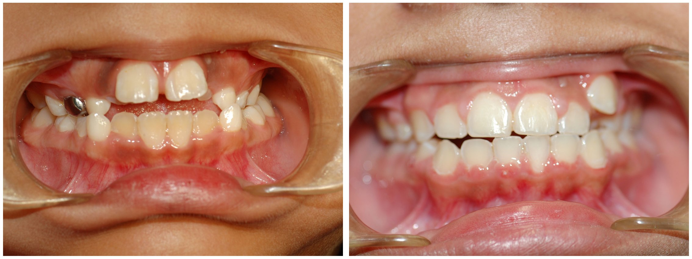 Orthodontist Dental Braces Before & After