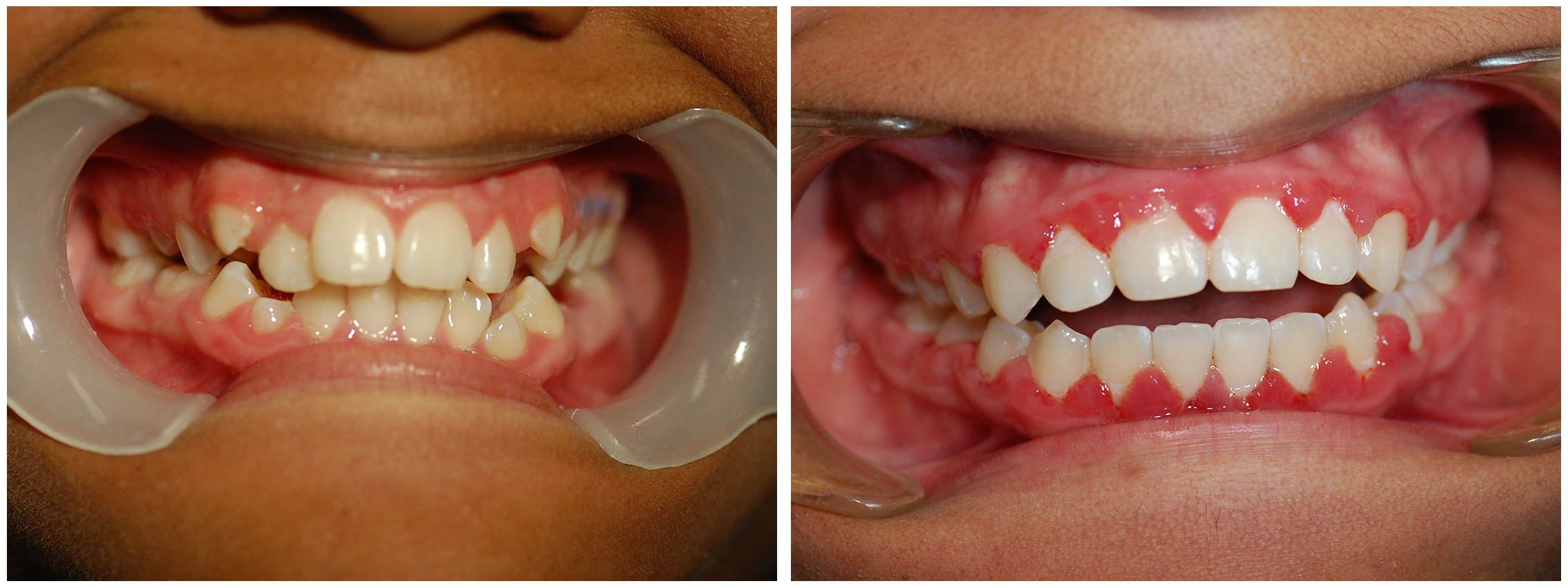 Orthodontist Dental Braces Before & After