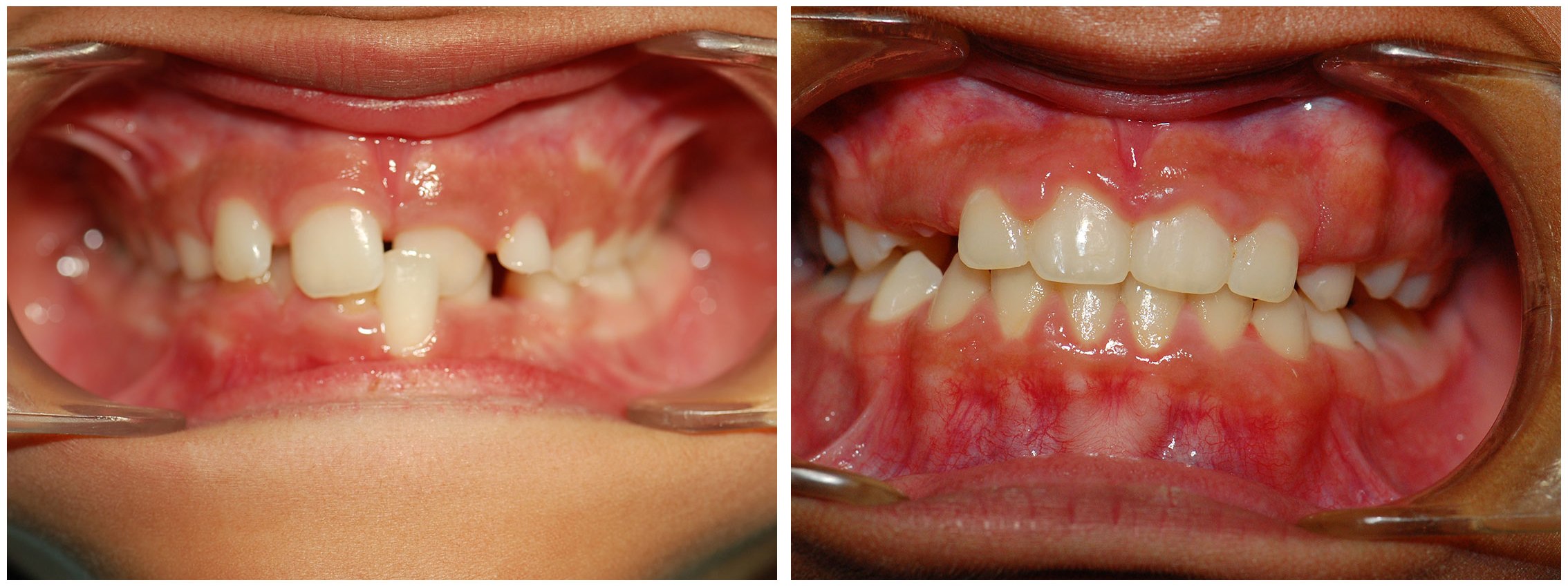 Orthodontist Dental Braces Before & After