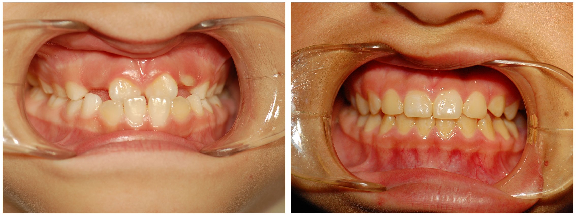 Pediatric Dental Braces Treatment Before & After