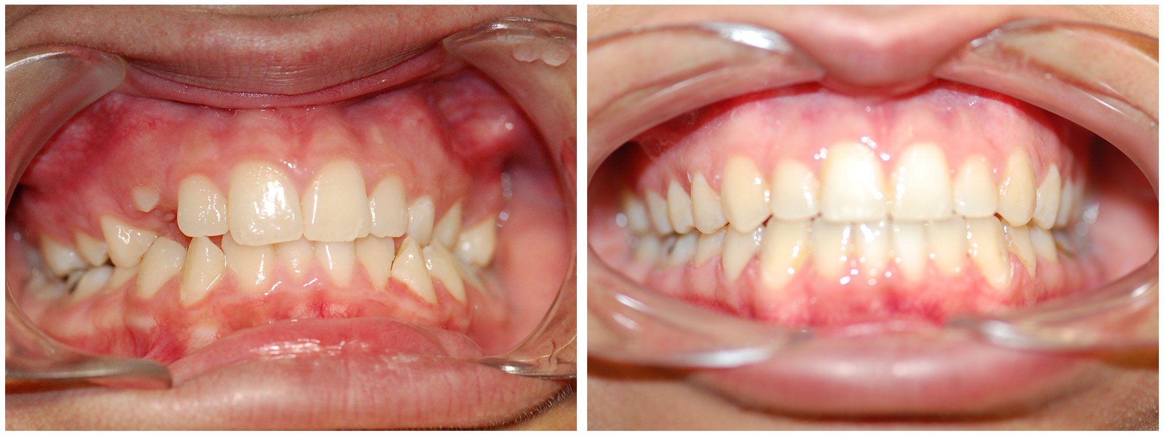 Pediatric Dental Braces Treatment Before & After