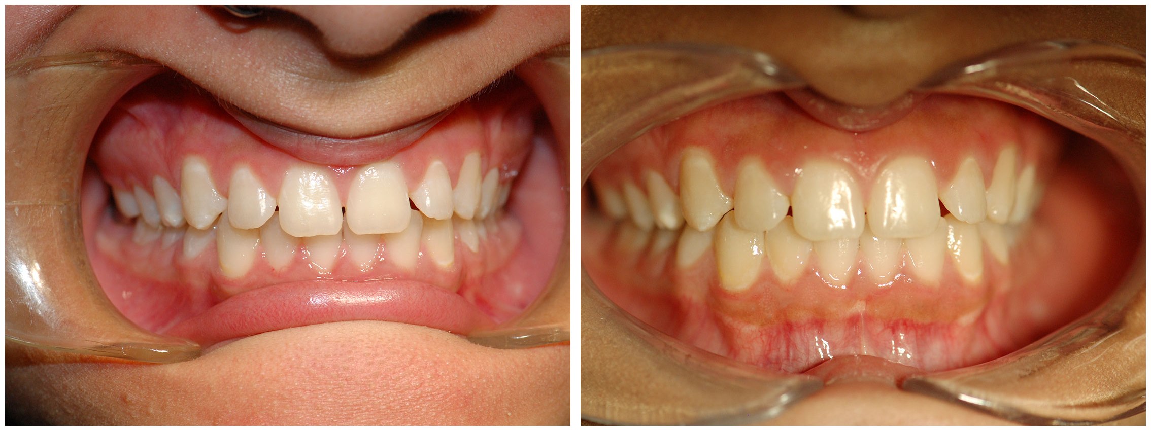 Pediatric Dental Braces Before & After