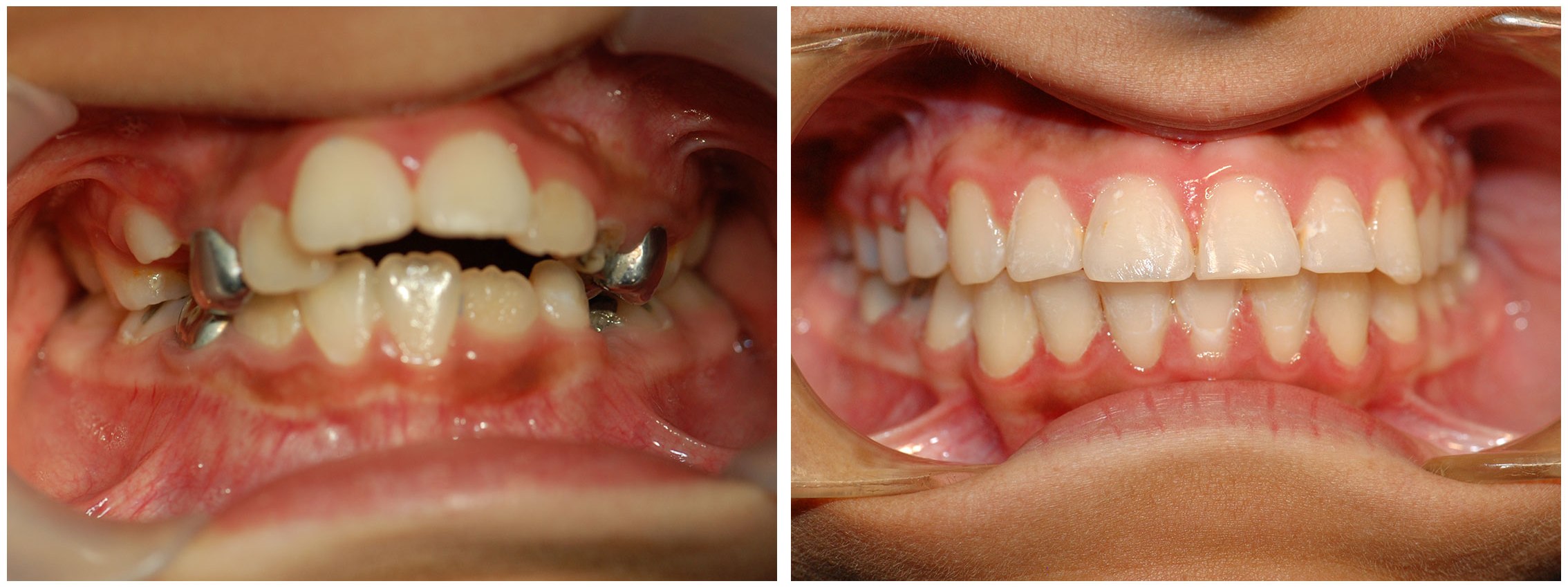 Pediatric Dental Braces Before & After