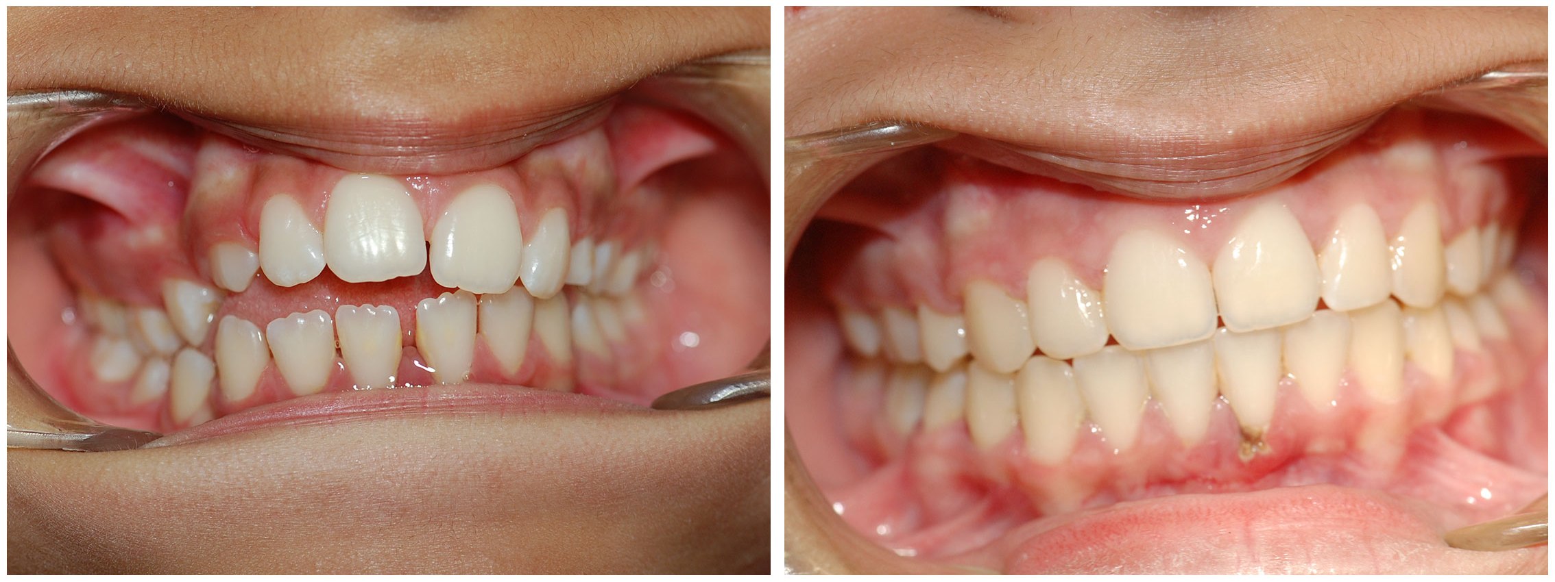 Pediatric Dental Braces Before & After