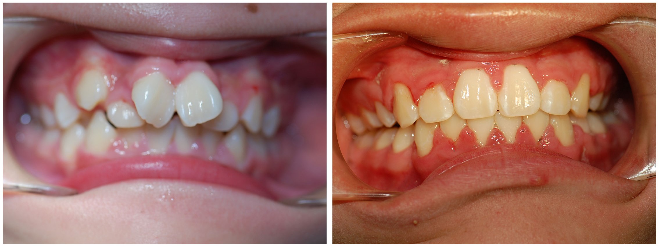 Pediatric Dental Braces Before & After