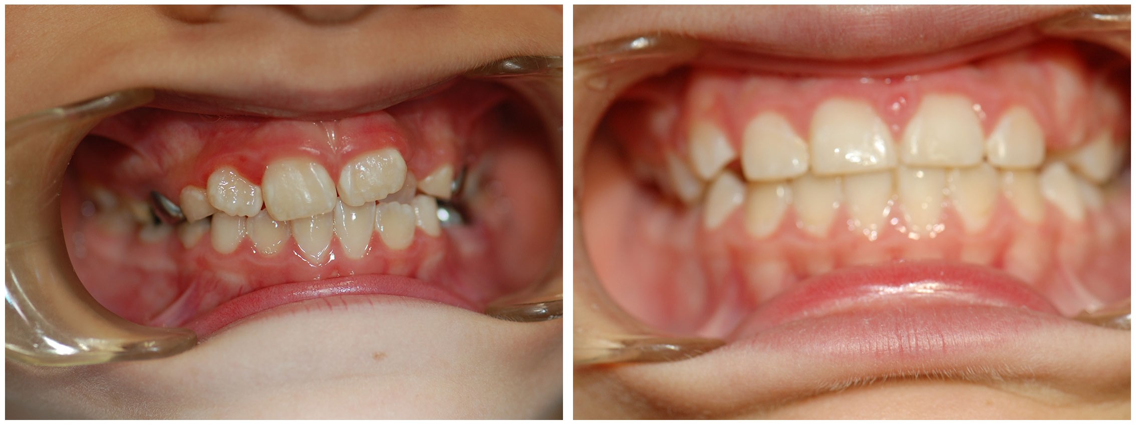 Pedodontic Dental Braces Before & After