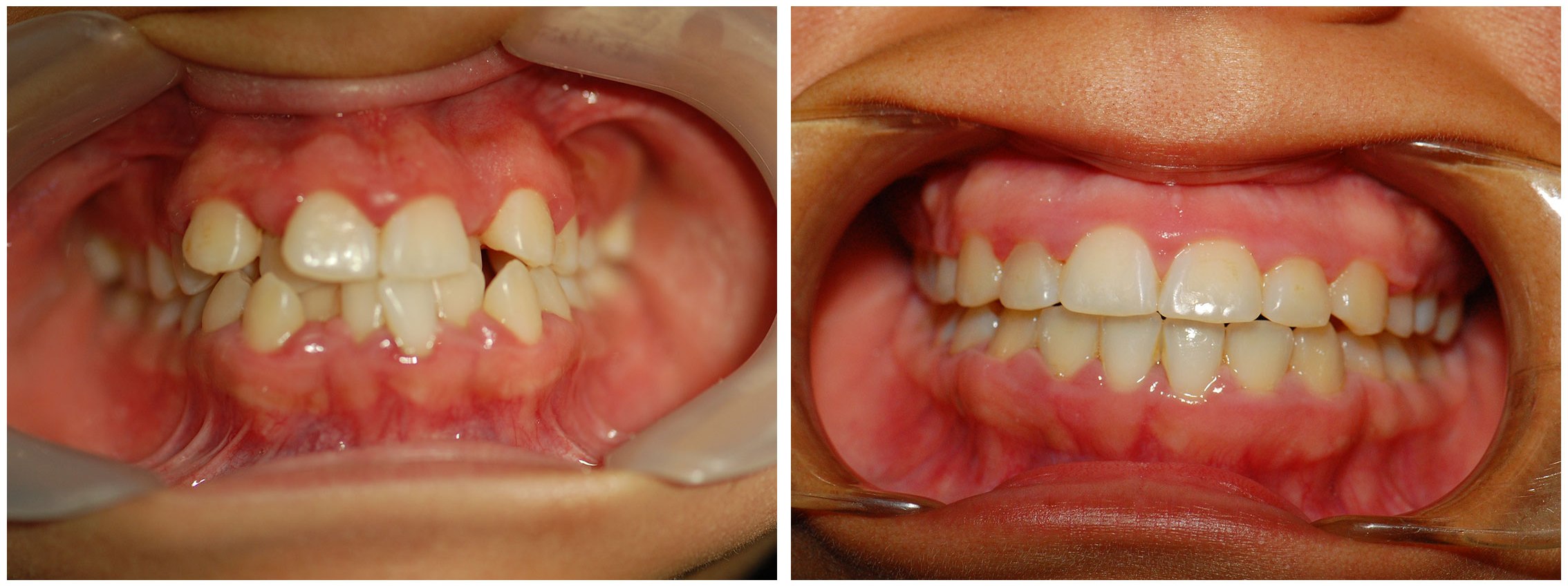 Pedodontic Dental Braces Before & After