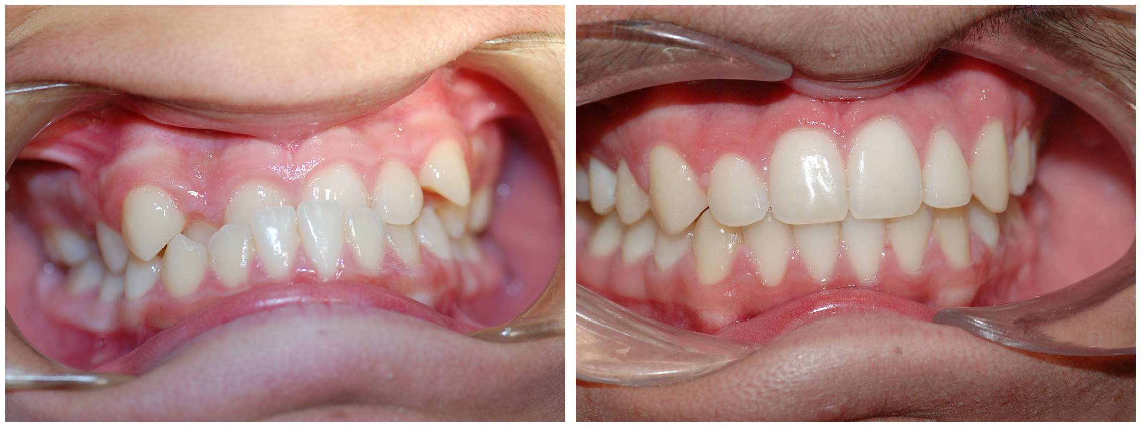 Pedodontic Dental Braces Before & After