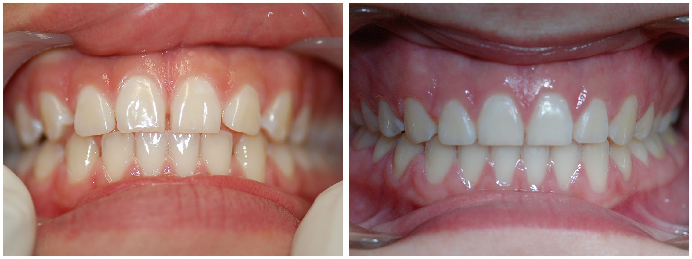 Pedodontist Dental Braces Treatment Before & After