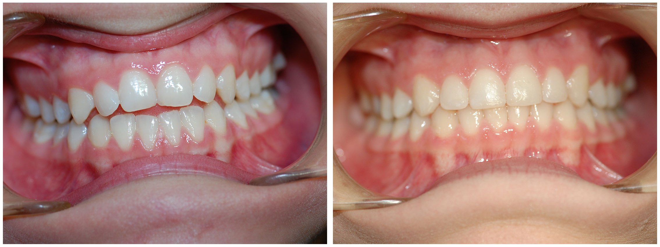 Pedodontist Dental Braces Before & After