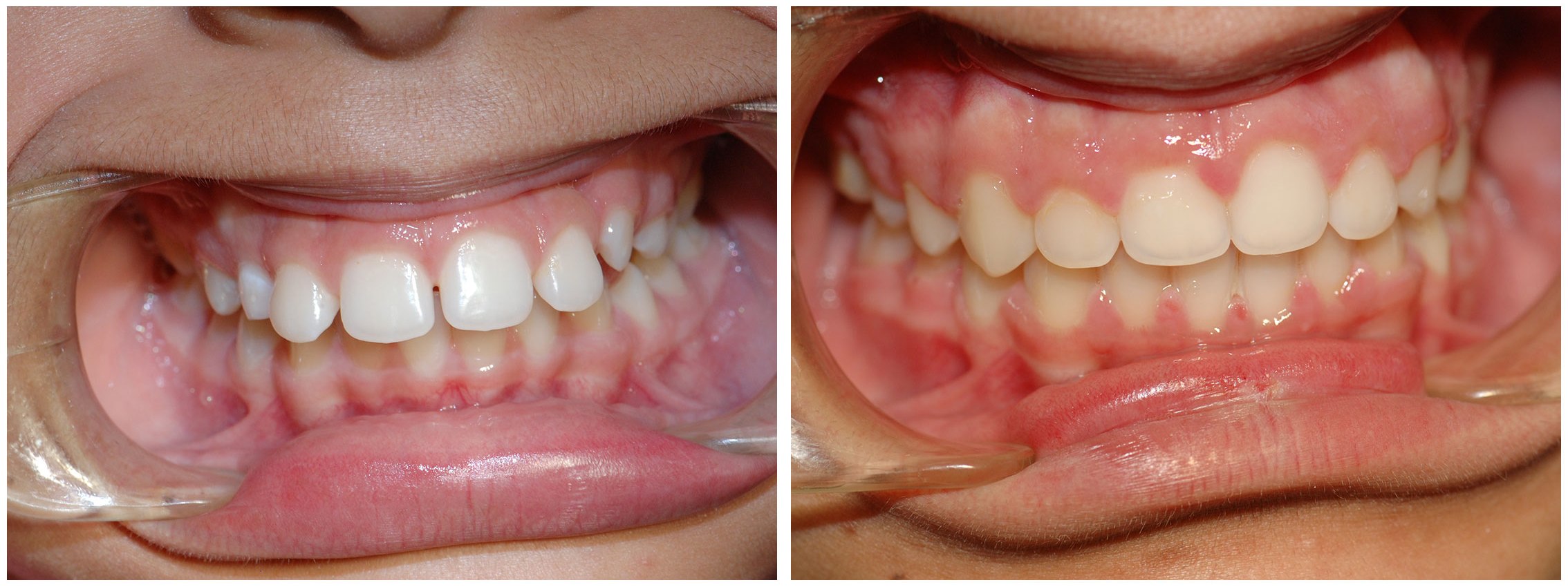 Pedodontist Dental Braces Before & After