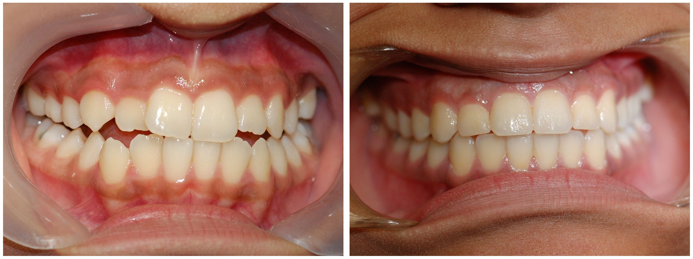 Periodontic Dental Braces Treatment Before & After