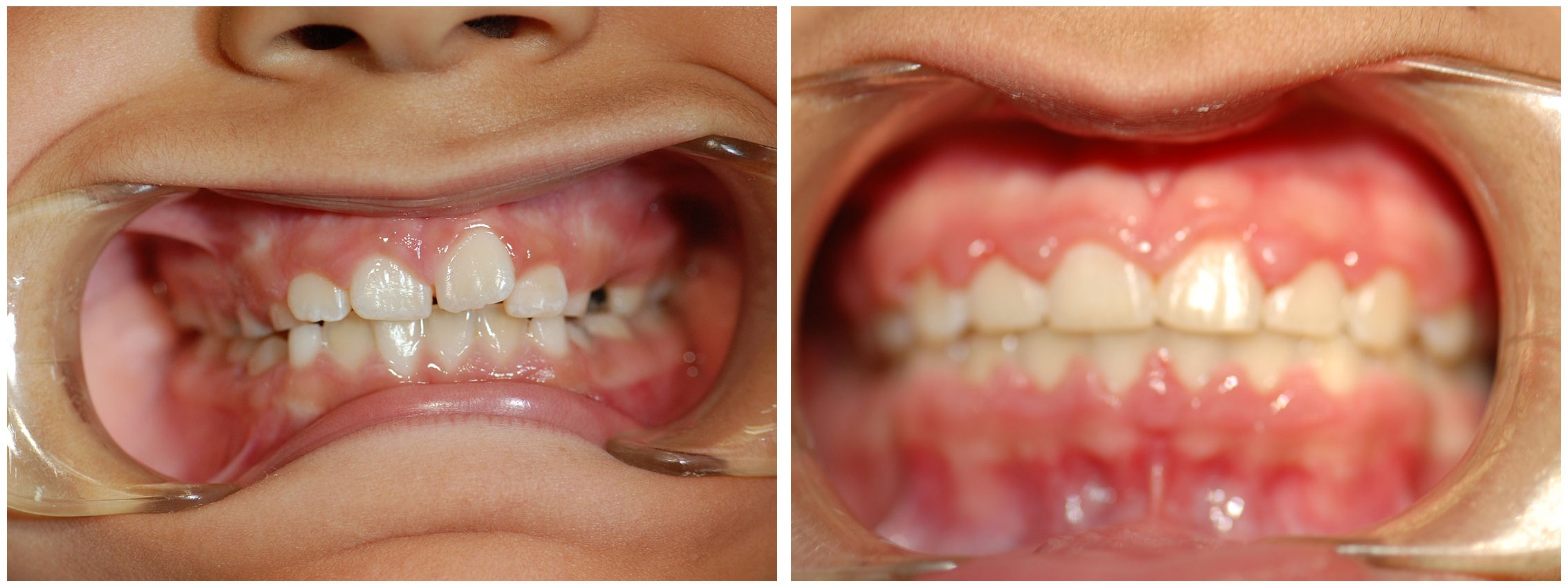 Periodontic Dental Braces Before & After