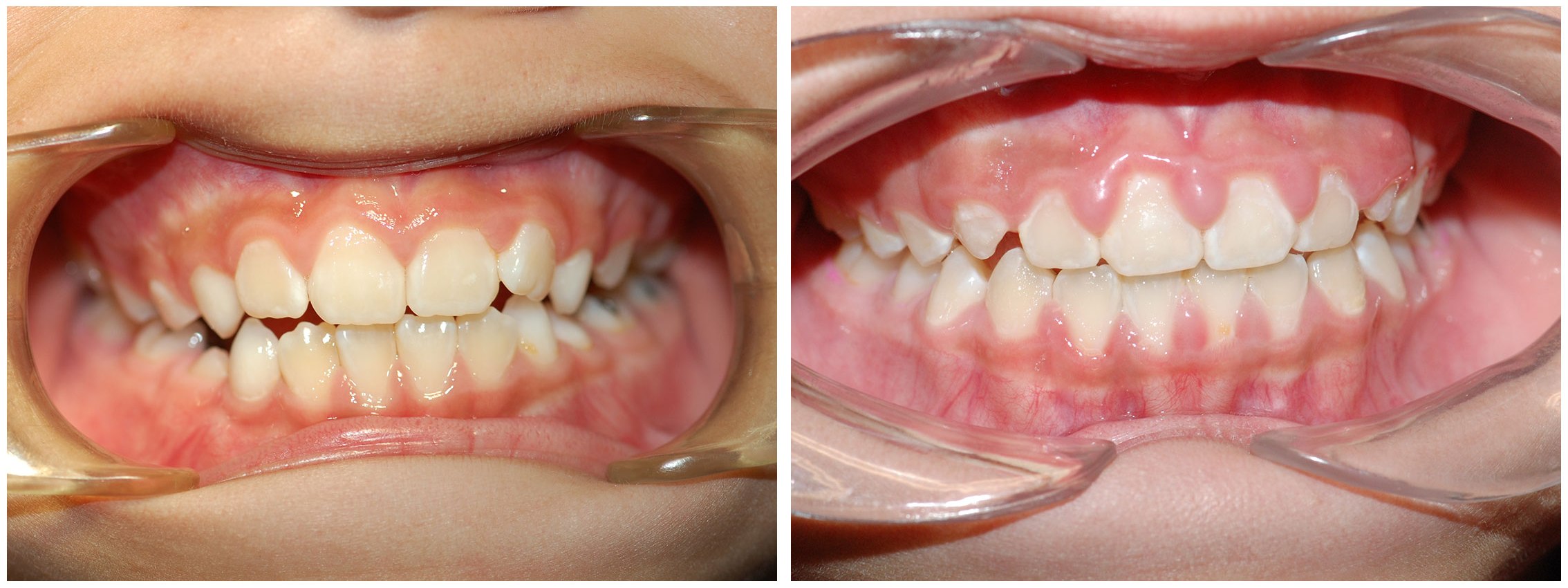 Periodontic Dental Braces Before & After