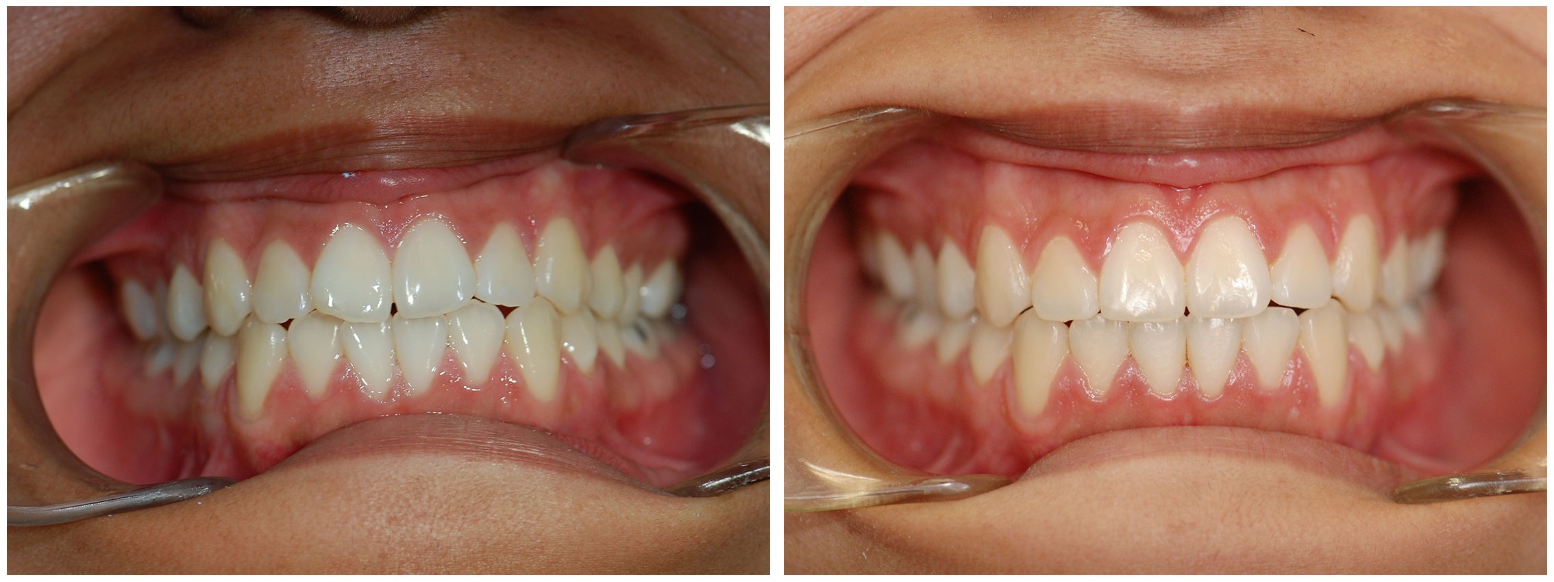 Periodontic Dental Braces Before & After