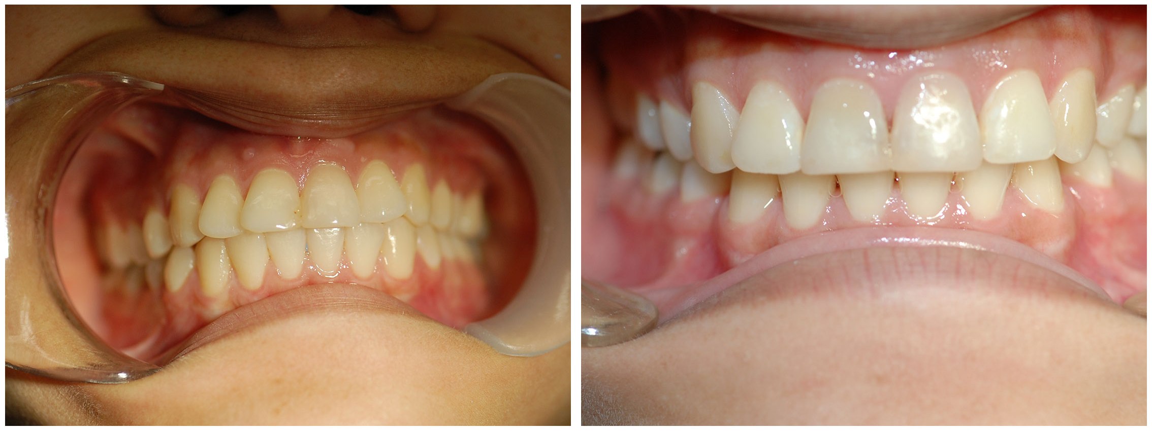 Periodontist Dental Braces Treatment Before & After