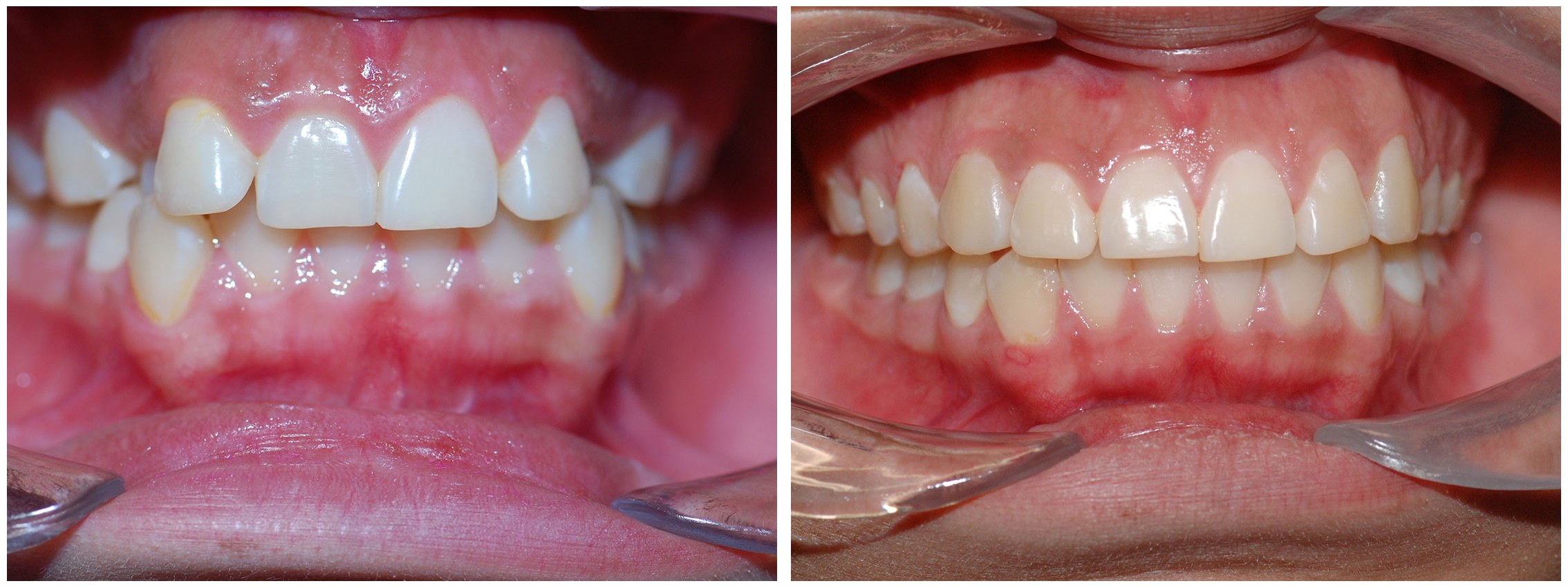 Periodontist Dental Braces Treatment Before & After