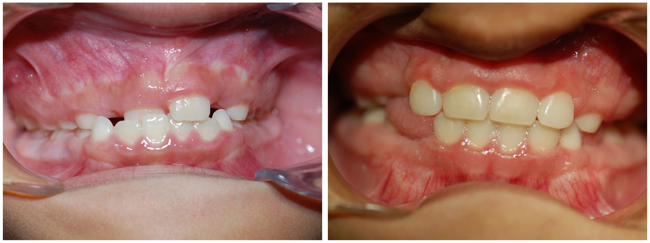 Periodontist Dental Braces Before & After