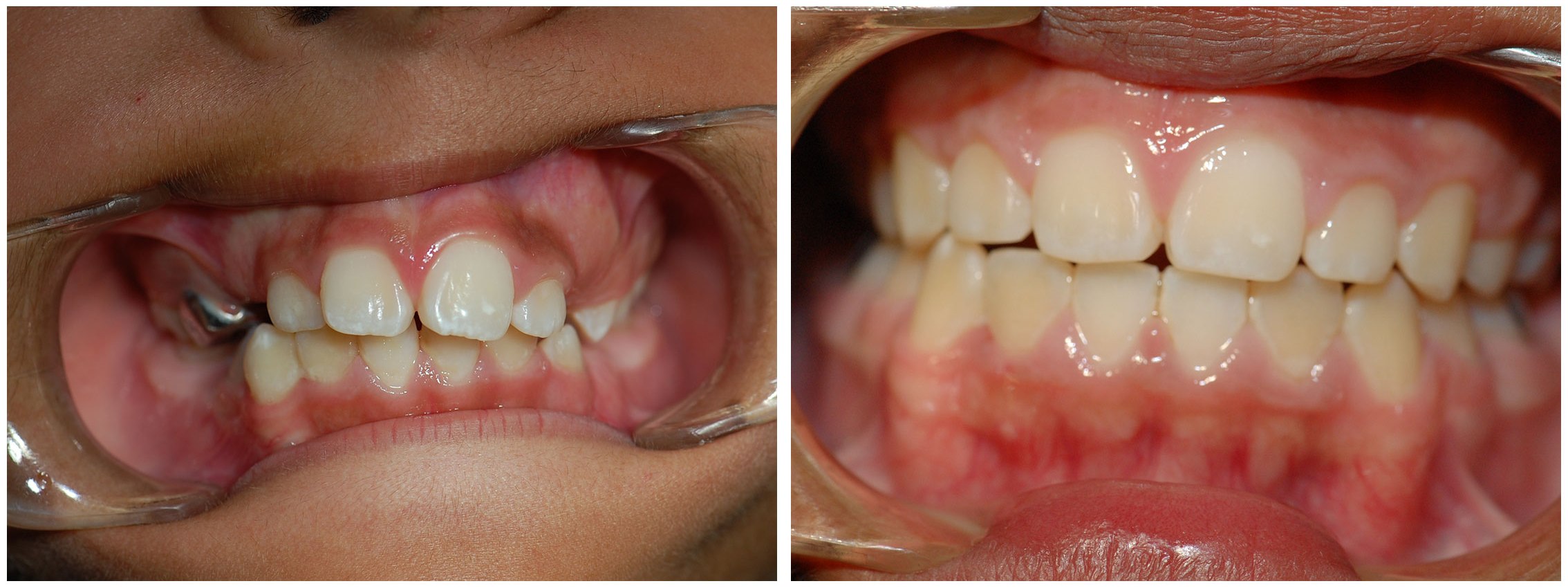 Periodontist Dental Braces Before & After