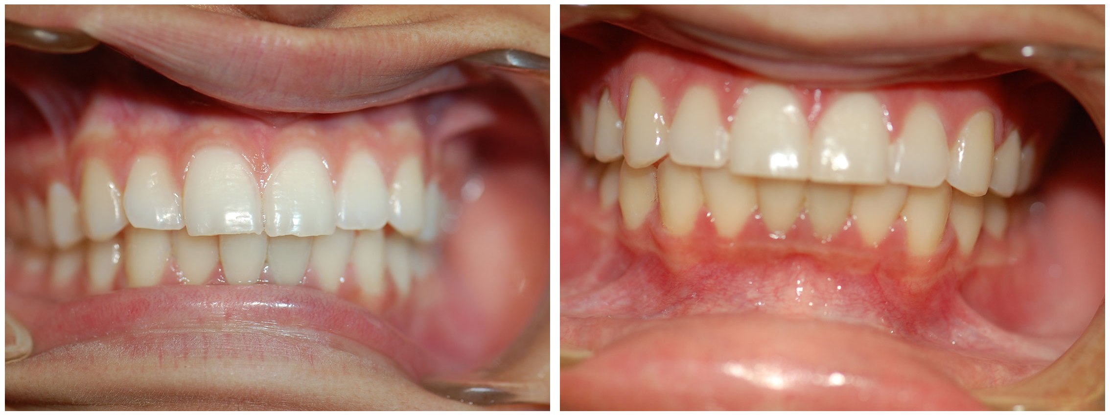 Periodontist Dental Braces Before & After