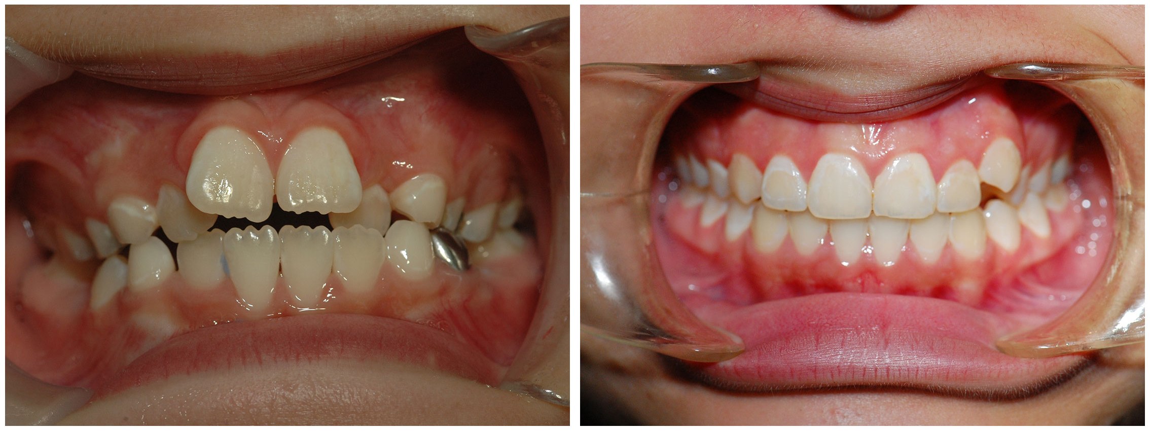 Periodontist Dental Braces Before & After