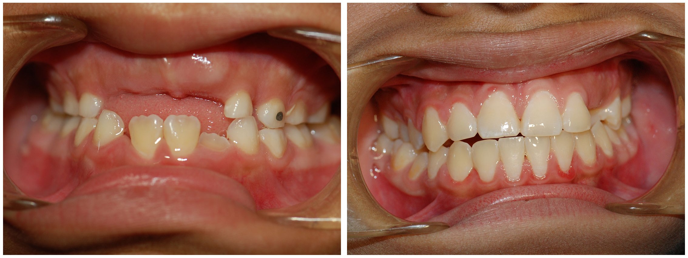 San Mateo Dental Braces Treatment Before & After