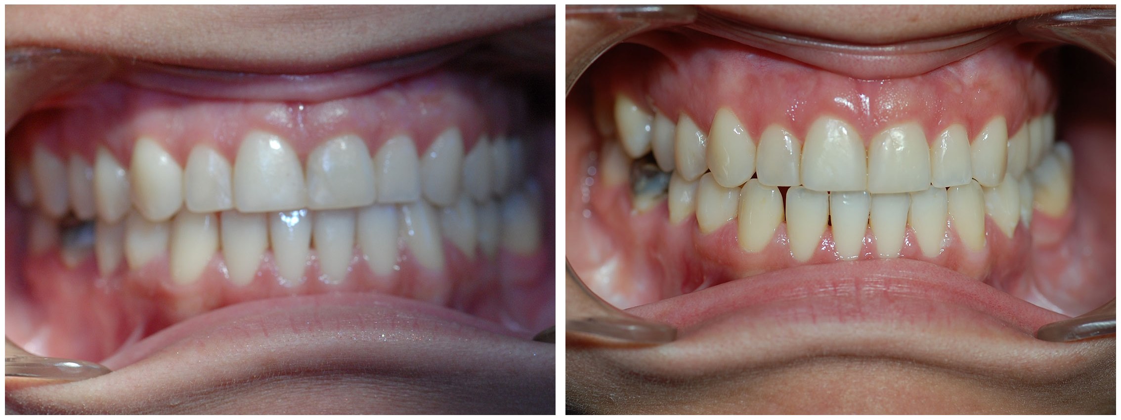 Teens Dental Braces Treatment Before & After