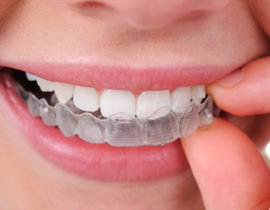Teeth Invisalign Braces